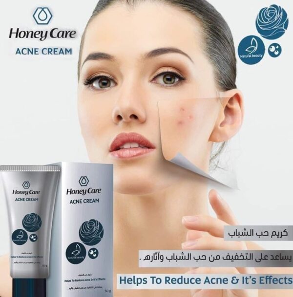 Acne Cream